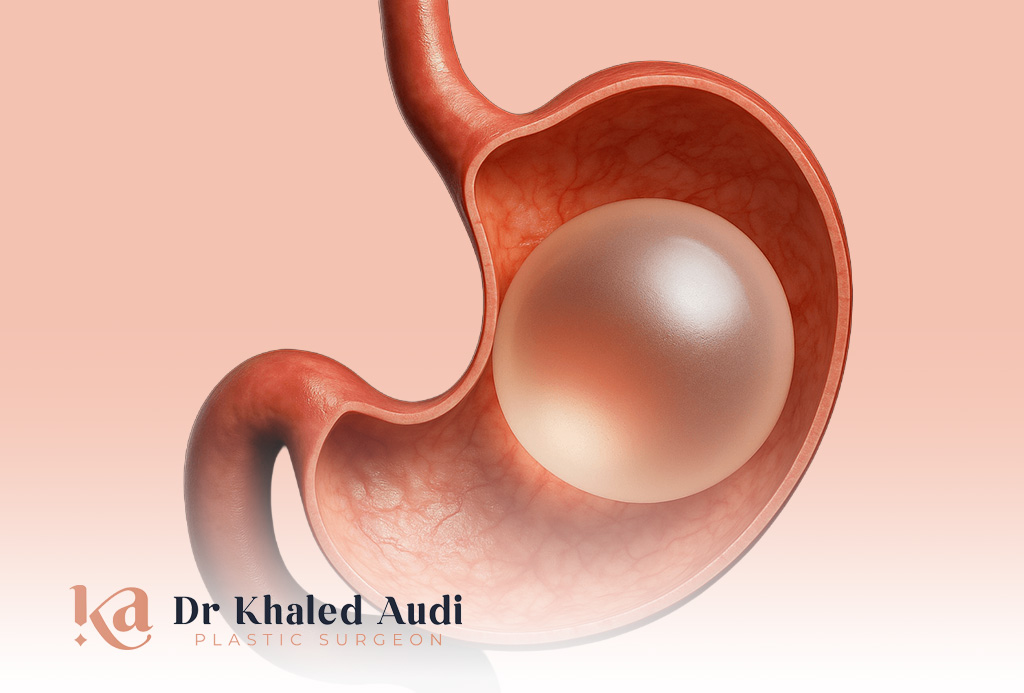 بالون-المعدة