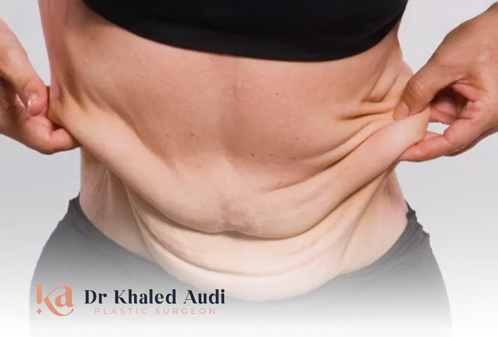 شد-الترهلات-بعد-عمليات-السمنة