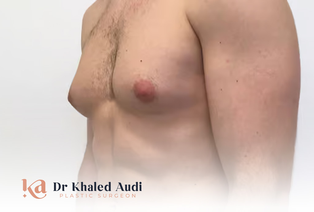 علاج-التثدي-عند-الرجال