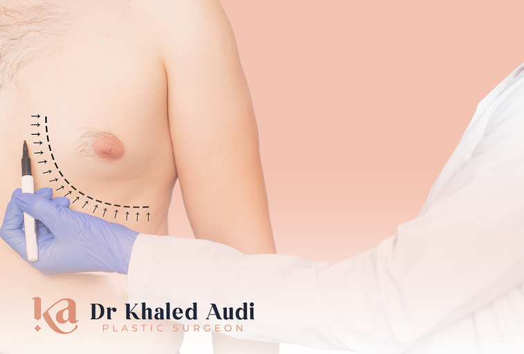 علاج-التثدي-عند-الرجال