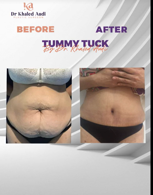 رحلة-شد-البطن