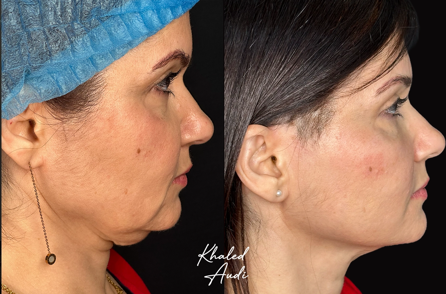 Liquid-Facelift