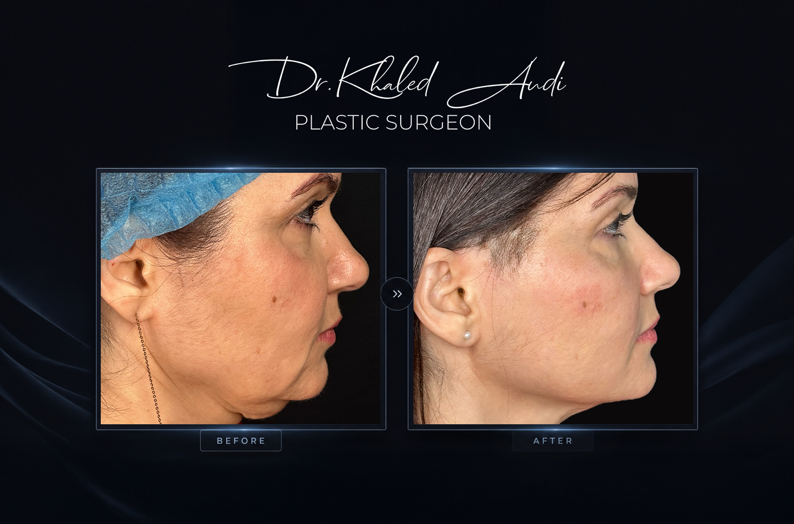 Liquid-Facelift