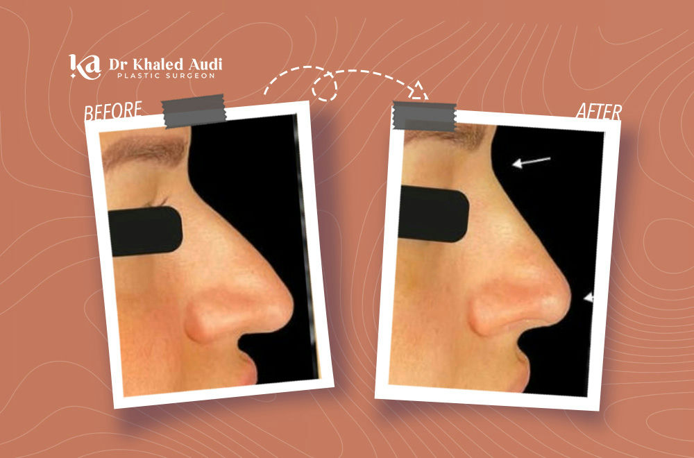 تجميل-الأنف-بدون-جراحة-باستخدام-الخيوط-فقط