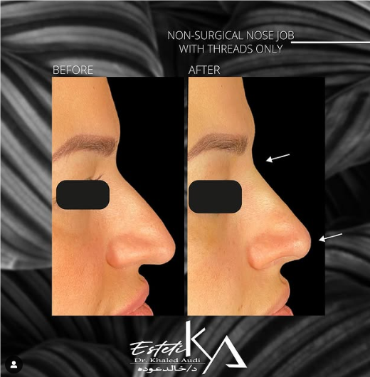 تجميل-الأنف-بدون-جراحة-باستخدام-الخيوط-فقط
