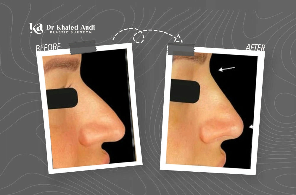 تجميل-الأنف-بدون-جراحة-باستخدام-الخيوط-فقط