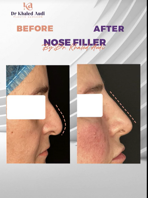 تحسين-فوري-لشكل-الأنف-بدون-جراحة