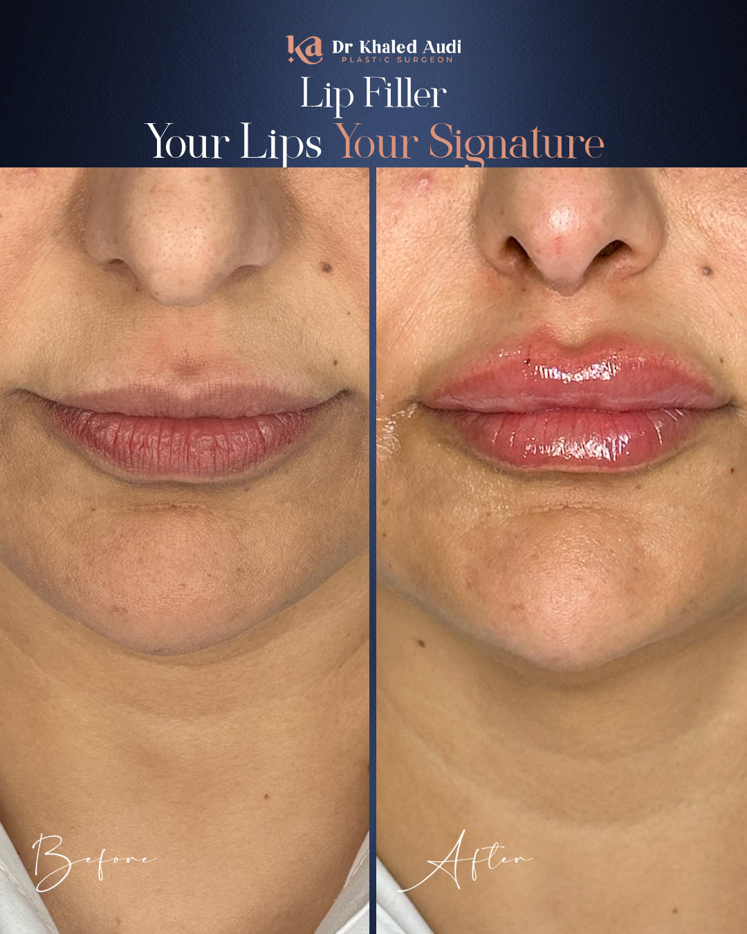 جمال-متجدد-للشفايف-بإبداع-الدكتور-خالد-عوده