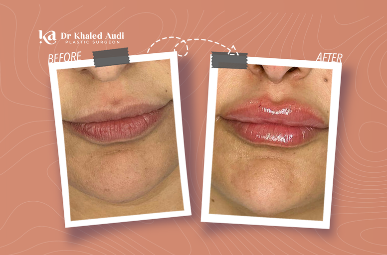 جمال-متجدد-للشفايف-بإبداع-الدكتور-خالد-عوده