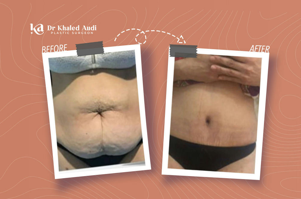 رحلة-شد-البطن