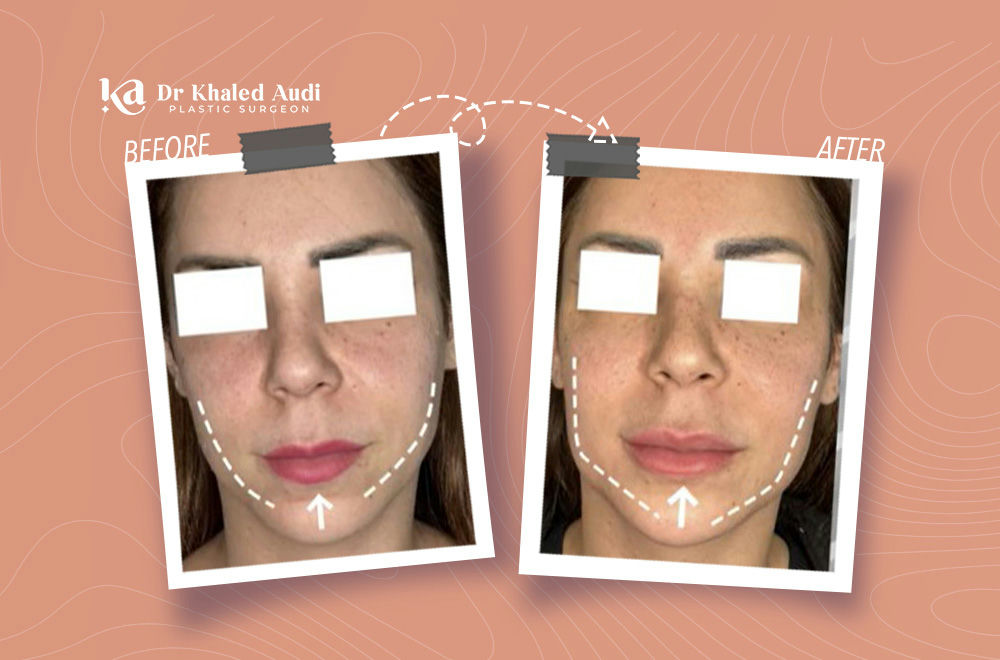 فيلر-الذقن-وخط-الفك