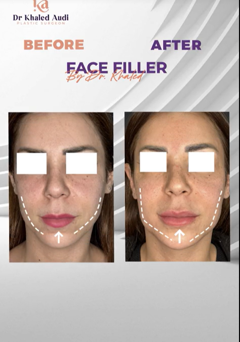 فيلر-الذقن-وخط-الفك