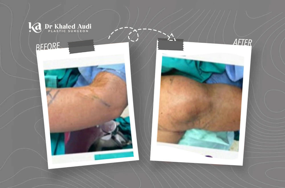 مظهر-رياضي-للذراعين-بنحت-دقيق-ونتائج-طبيعية