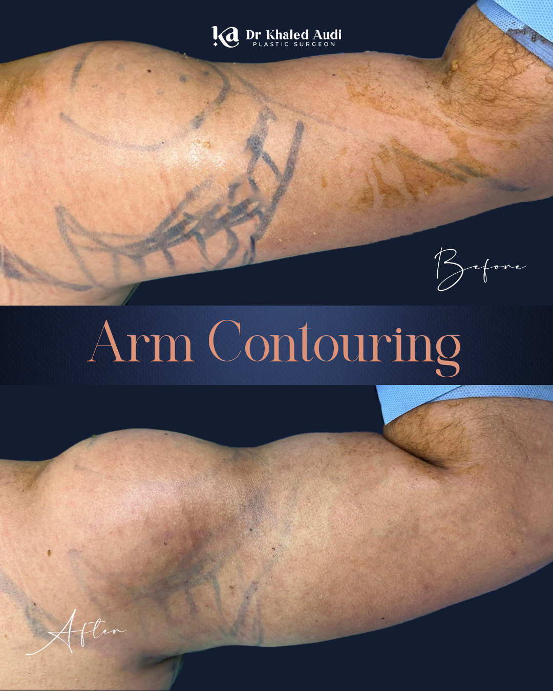 مظهر-رياضي-للذراعين-بنحت-دقيق-ونتائج-طبيعية