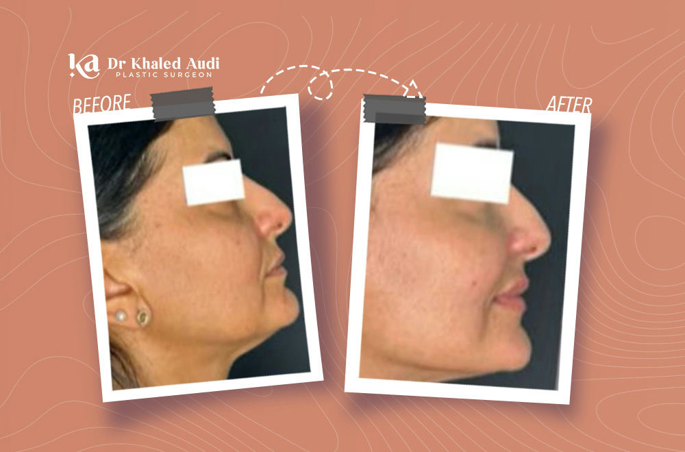 نضارة-بدون-جراحة-مع-شد-الوجه-بالخيوط