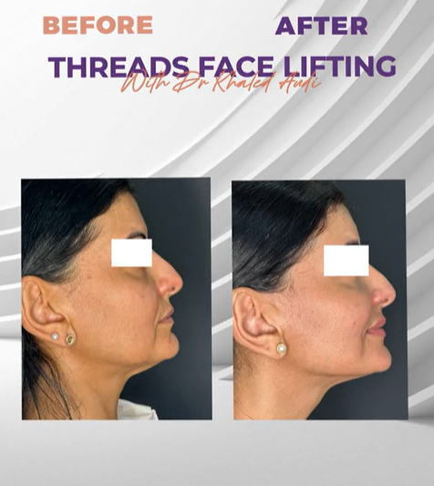 نضارة-بدون-جراحة-مع-شد-الوجه-بالخيوط