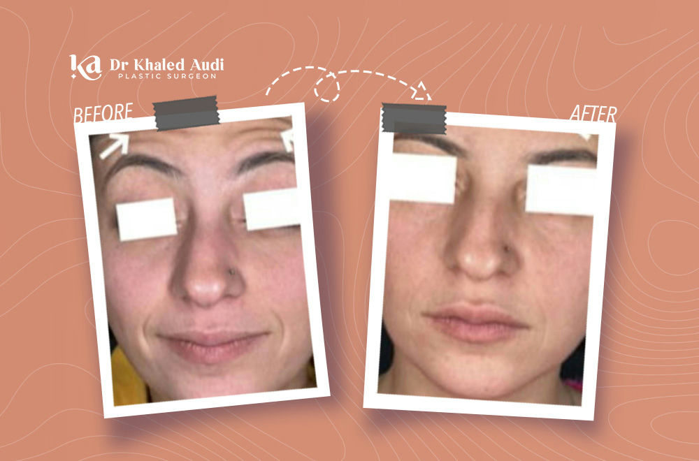 ودعت-تجاعيد-الجبهة-واستعادت-ملامحها-الشابة-من-جديد