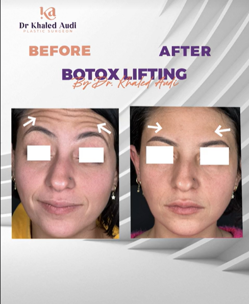 ودعت-تجاعيد-الجبهة-واستعادت-ملامحها-الشابة-من-جديد